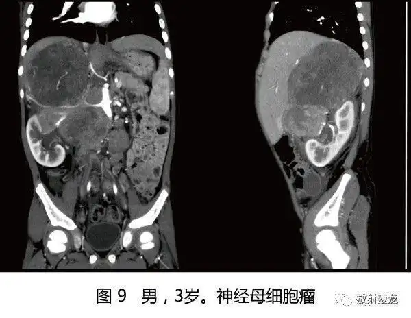 (2)肾细胞癌儿童6岁前罕见.