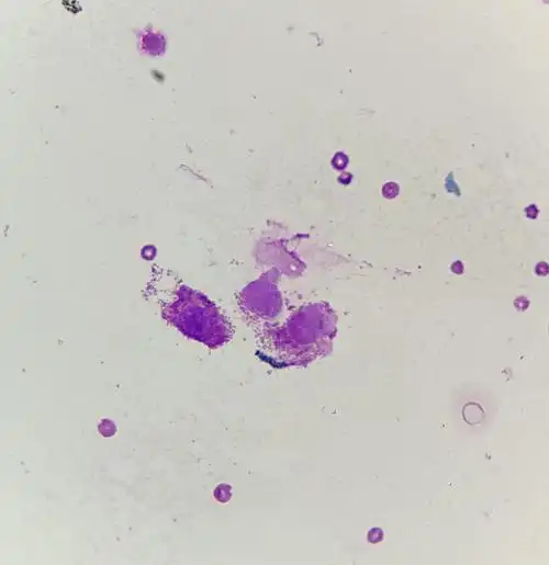 【讨论】更新:医院怀疑肥大细胞瘤_想请问大家有没.