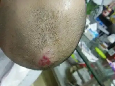 宝宝20多天发现头上长血管瘤,去医院医生让观察:现在长了有两个月了