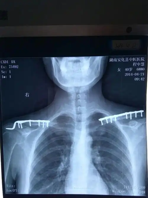 锁骨骨折手术后缝隙过大"一句慢慢会好的"导致五年骨痛,不愈合