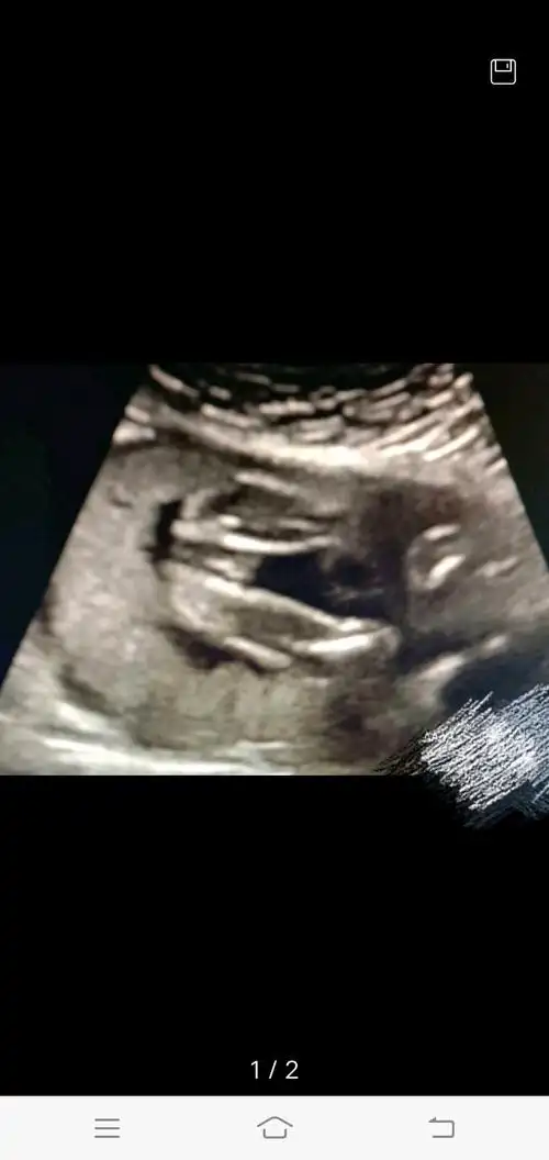 孕33周 2天恩施土家族苗族自治州             #生男生女猜猜猜?