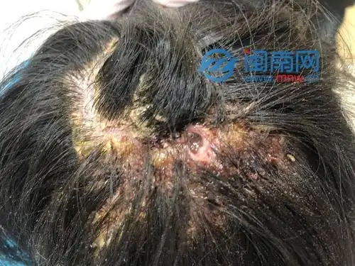 泉州一女子头皮痒了3个月,竟从头皮内取出6只蛆!