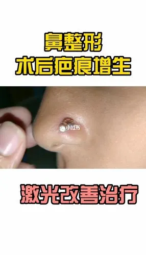 鼻整形术后疤痕增生