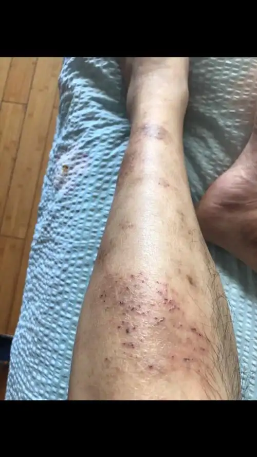 成人小腿部湿疹治疗前后