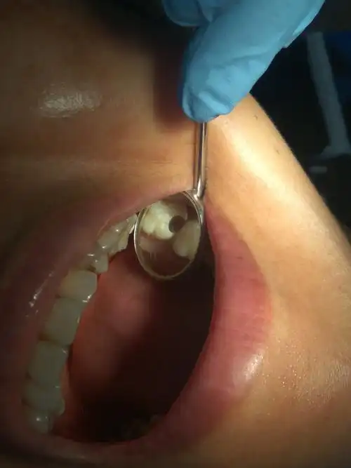 龋洞清理后的照片