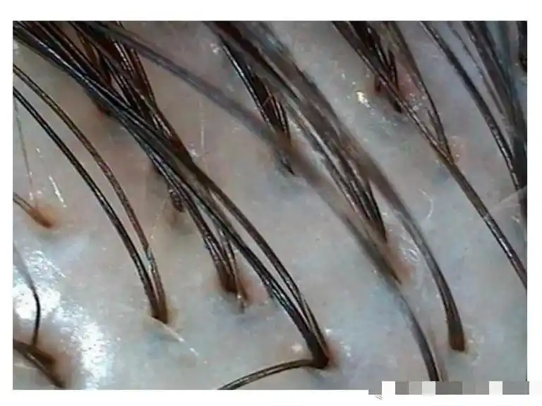 毛囊检测下不同的头皮状态.