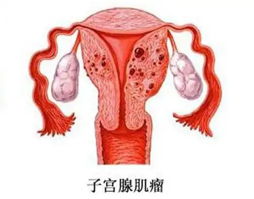 子宫腺肌症影响美国试管婴儿囊胚移植吗