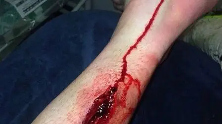 男子腿疼不已,邻居在他腿上划了一道口子,他笑着说谢谢