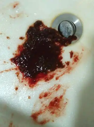 4 6楼 你去医院查查啊,吐血我觉得要小心啊 5楼菲小蛋':我今天土