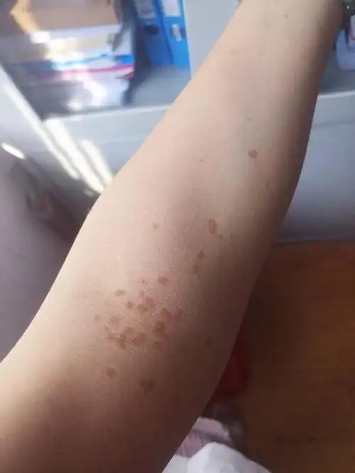 手臂上长这个斑点十来年了,不痛不痒,请问这是怎么回事