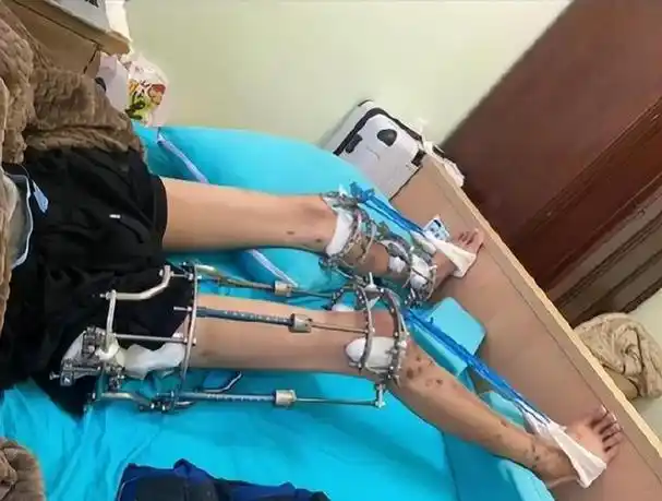 断骨增高手术,看似简单的操作却隐藏着无尽的痛苦.