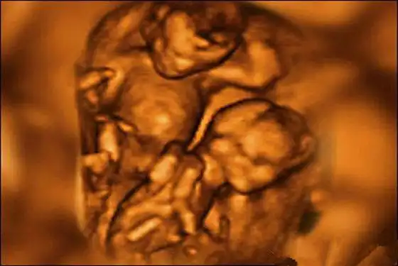双胞胎四维彩超图片双胞胎做四维彩超的最佳时间