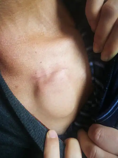 血脂博士谈健康心脏起搏器安装后注意事项