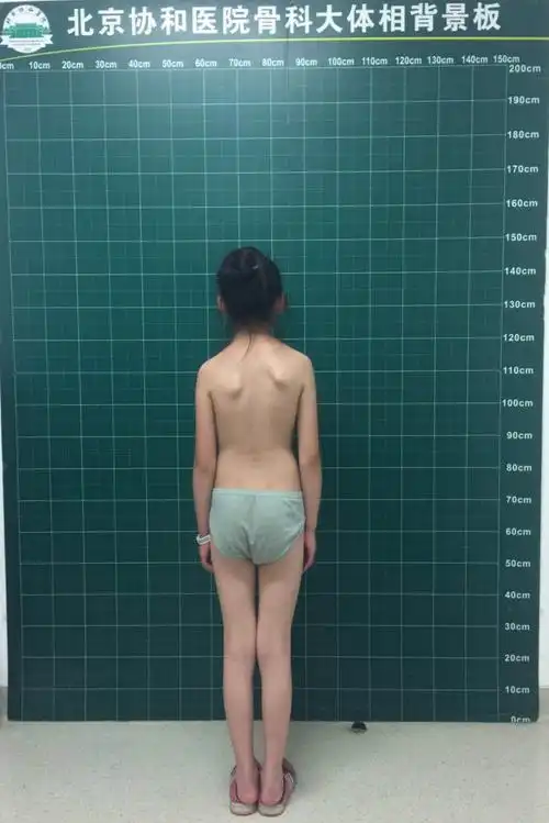 行走的艺术,凝固的音乐--典型病例:10岁女孩,先天性脊柱侧凸,截骨矫形
