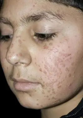 扁平疣来了,你想咋治?