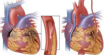 冠状动脉旁路搭桥术