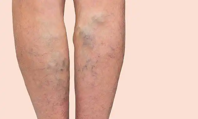 长的越高,越有可能患静脉曲张