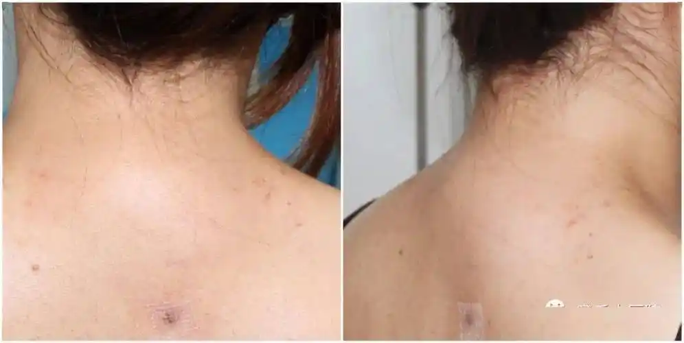 【健康章丘】章丘中医院仅用4mm切口抚平"富贵包"_手术