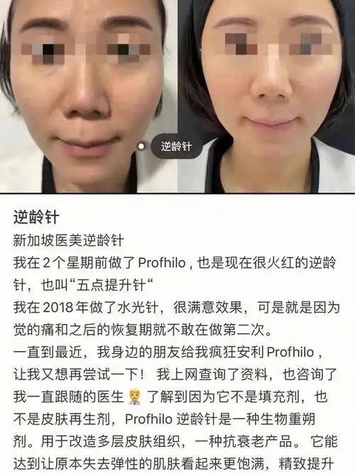 瑞士profhilo五点提升针