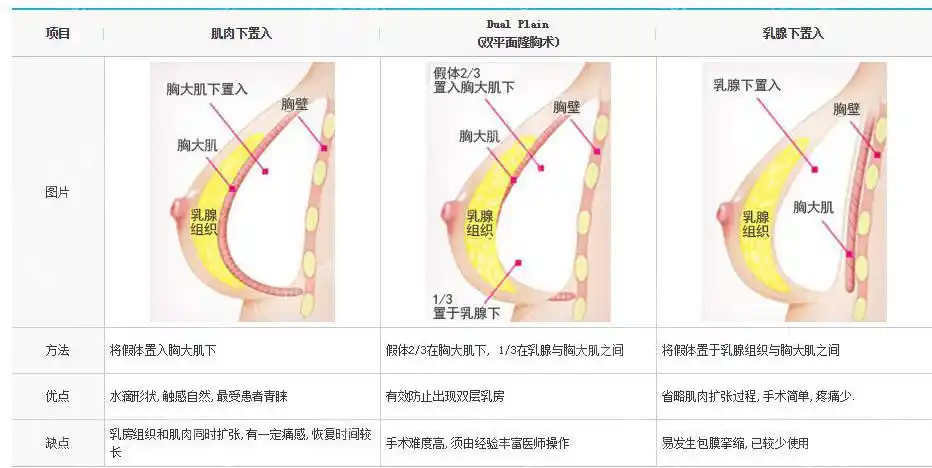 假体植入胸腔位置应该如何选择?