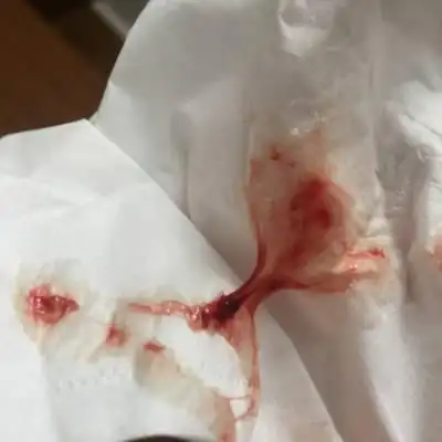 怀孕有五个半月了,最近半个月总是嗓子里有痰,咳出来就有好多血,鼻子