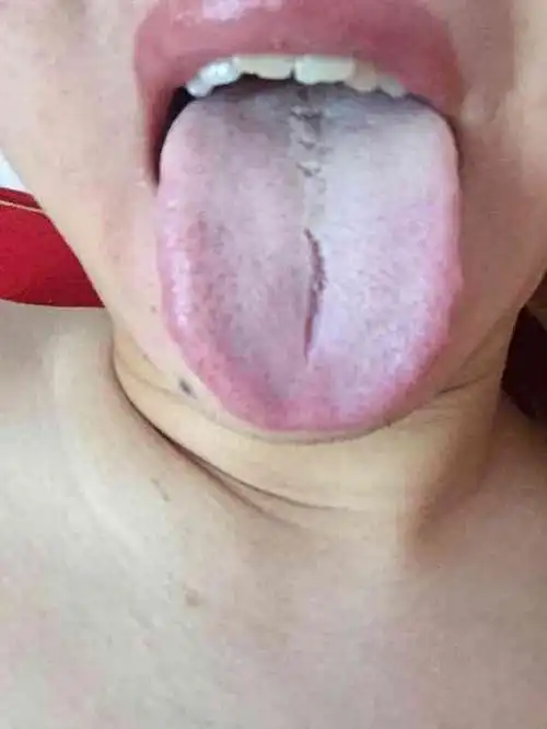 2,看舌苔你的情况是肝郁气滞,心情不好,舌苔虽少,症状的主要是易怒