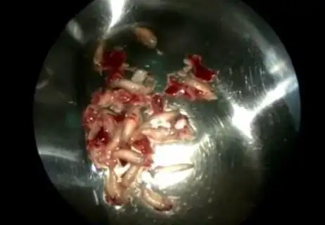 加拿大女子眼鼻钻出120只活蛆台媒太吓人图