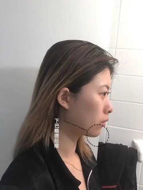 整个下颌面突出怎么办?