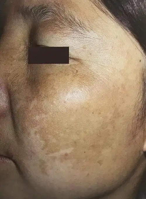 原来这种常见的斑叫褐青色痣_痣_症状表现_治疗方式 - 好大夫在线