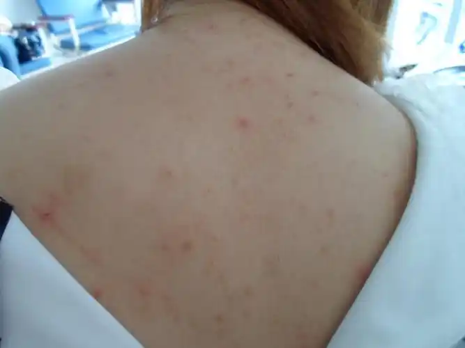 请大家看一下这是什么皮肤病?