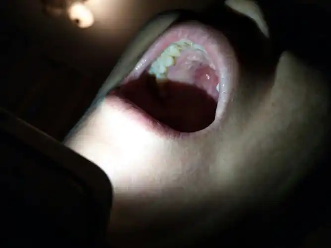 口腔上颚刚开始是起水泡,后面开始破了之后就开始溃烂.