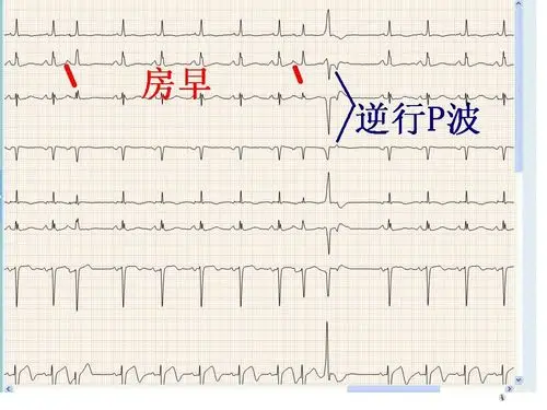 附加险怎么赔 终身寿险附加险