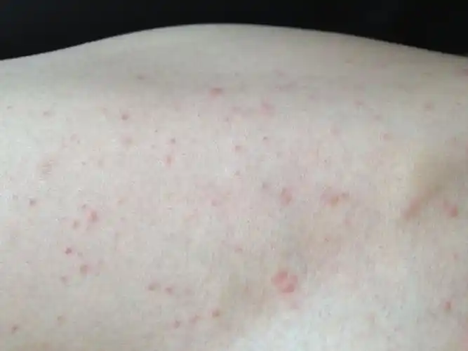 不慎接触艾滋病毒有72小时自救, 艾滋病初期症状