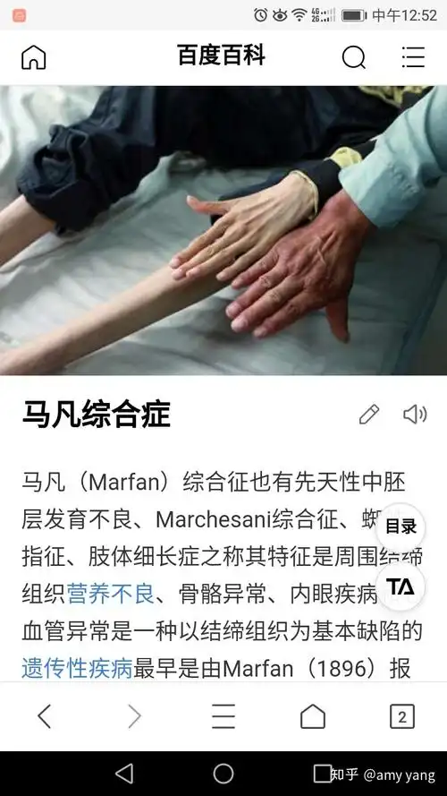 蜘蛛小美女马凡氏综合征