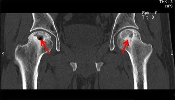 关节间隙狭窄,髋臼出现坏死变化,囊性变,囊肿和骨刺Ⅳ期c 新月征长度>