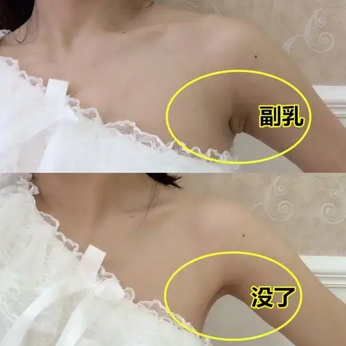 特价消副乳_【抖音同款】买2送1 收消副乳神器 去结节淋巴散结膏腋下