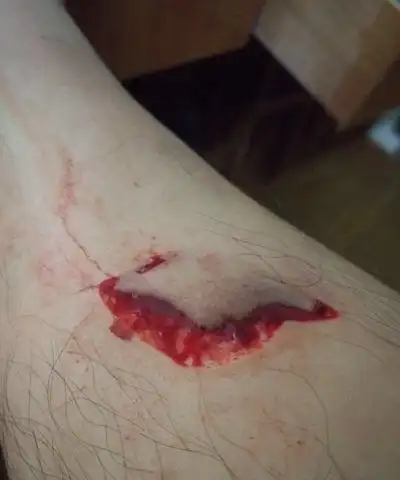 60岁男性因小小的划伤血难止 医生:血管堵了