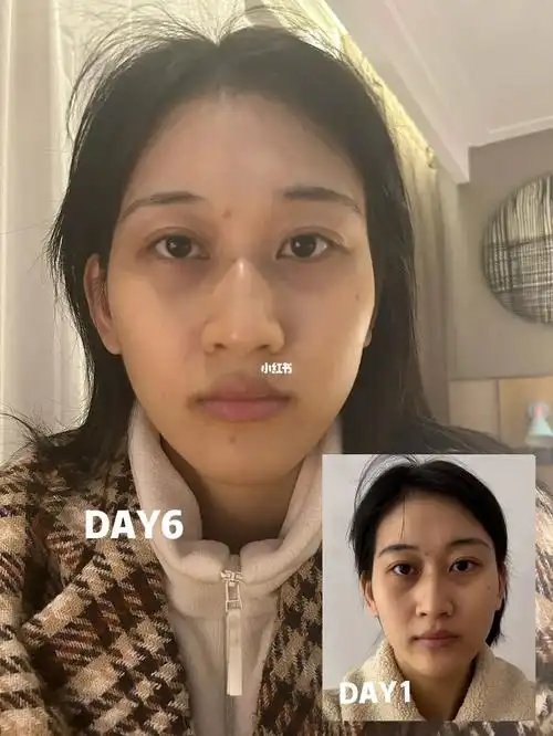 咬胶矫正大小脸第六天