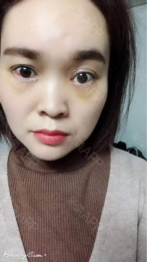 河笑平外切去眼袋第7天美丽日记