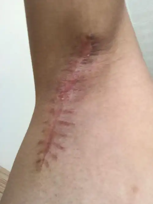 腋臭切除术的伤疤要多久才会不明显,伤口很大,很明显