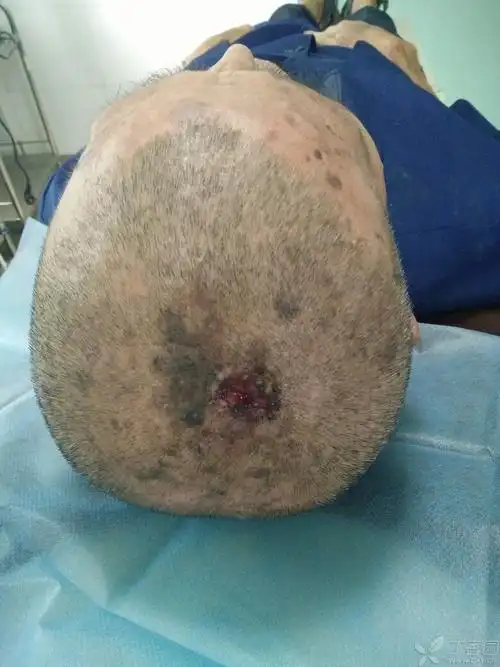 老年鳞状细胞癌 - 皮肤与性传播疾病讨论版 -丁香园论坛