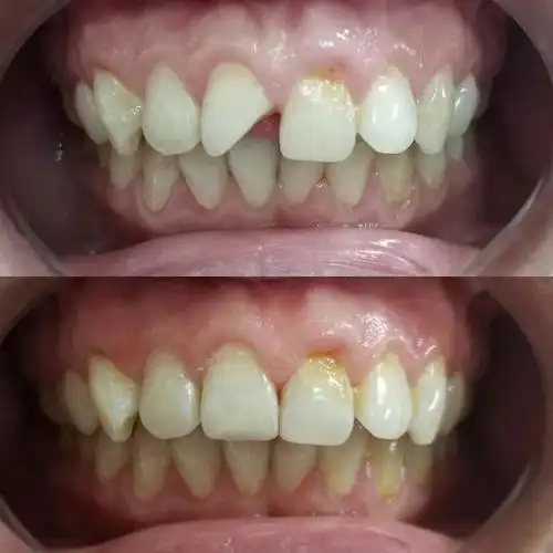 我的牙齿稀疏怎么办?