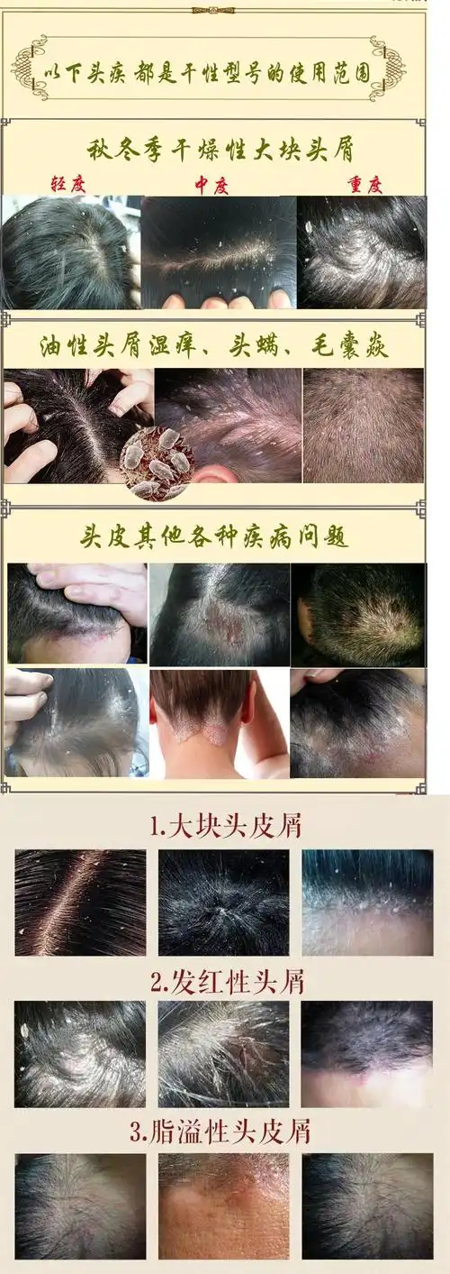 2,可能是脂溢性皮炎
头皮屑在医学上称为头皮糠疹,是一种由