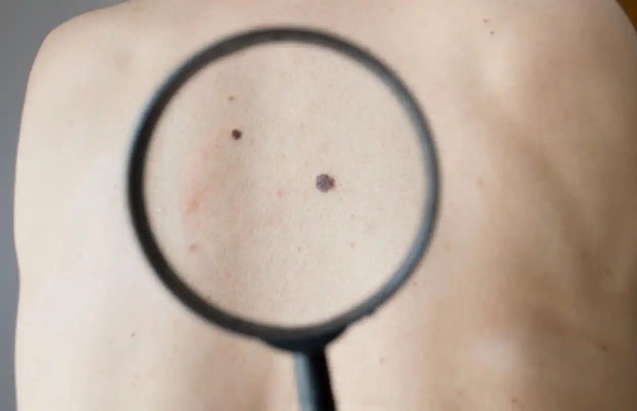 【小伙腿上黑痣增大竟是黑色素瘤 】近日,家住长沙市天心区的吴哲(化