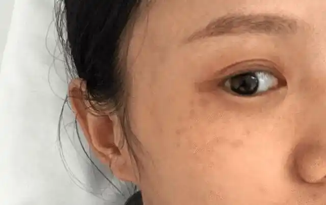 原来刘女士高中时肤质白皙细腻,是班里面公认的皮肤好,可年过三十,刘