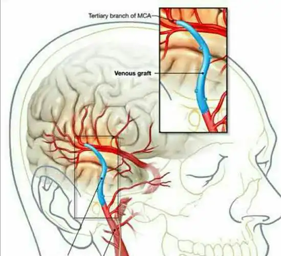 "颅内外血管搭桥术"——愿世间美好与你环环相扣!