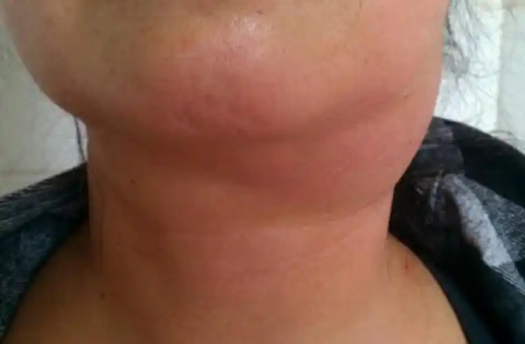 下颌淋巴结肿大可能是什么原因引起的?