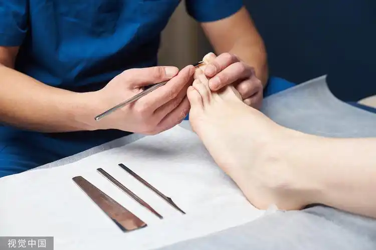 朋朋修脚在处理灰指甲,鸡眼上的利润,曾高达60-70%.