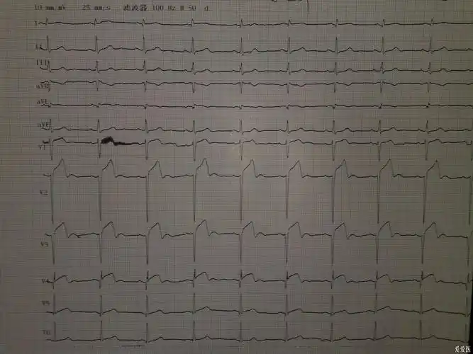 急性广泛前壁心肌梗死的典型心电图动态改变