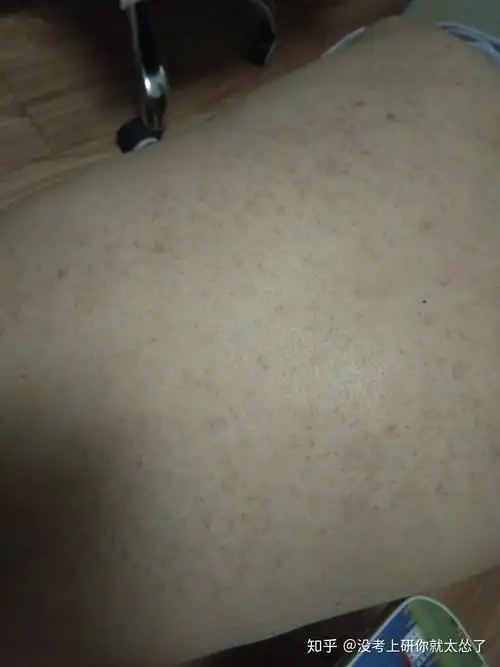 背部这个到底是不是毛囊炎 - 知乎